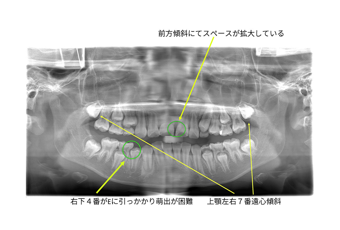 初診時：パノラマ所見