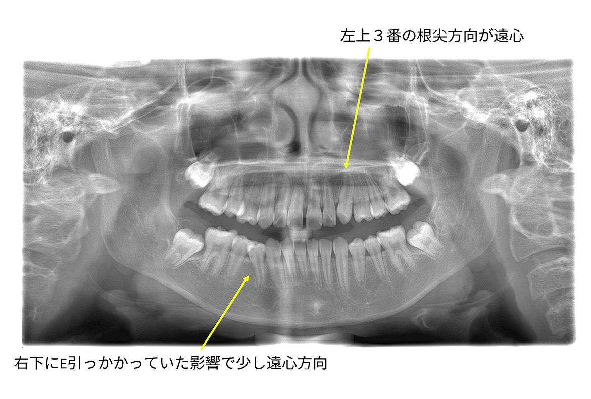 令和5年4月12日：パノラマ所見