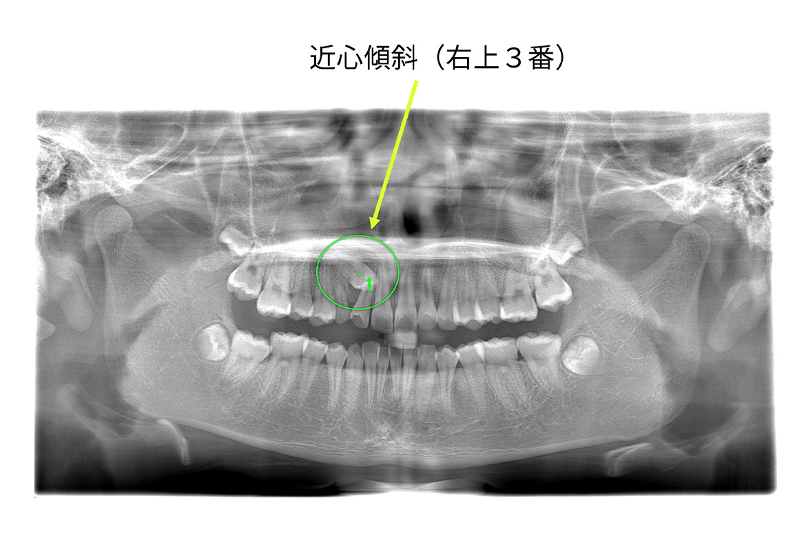 初診時：パノラマ所見