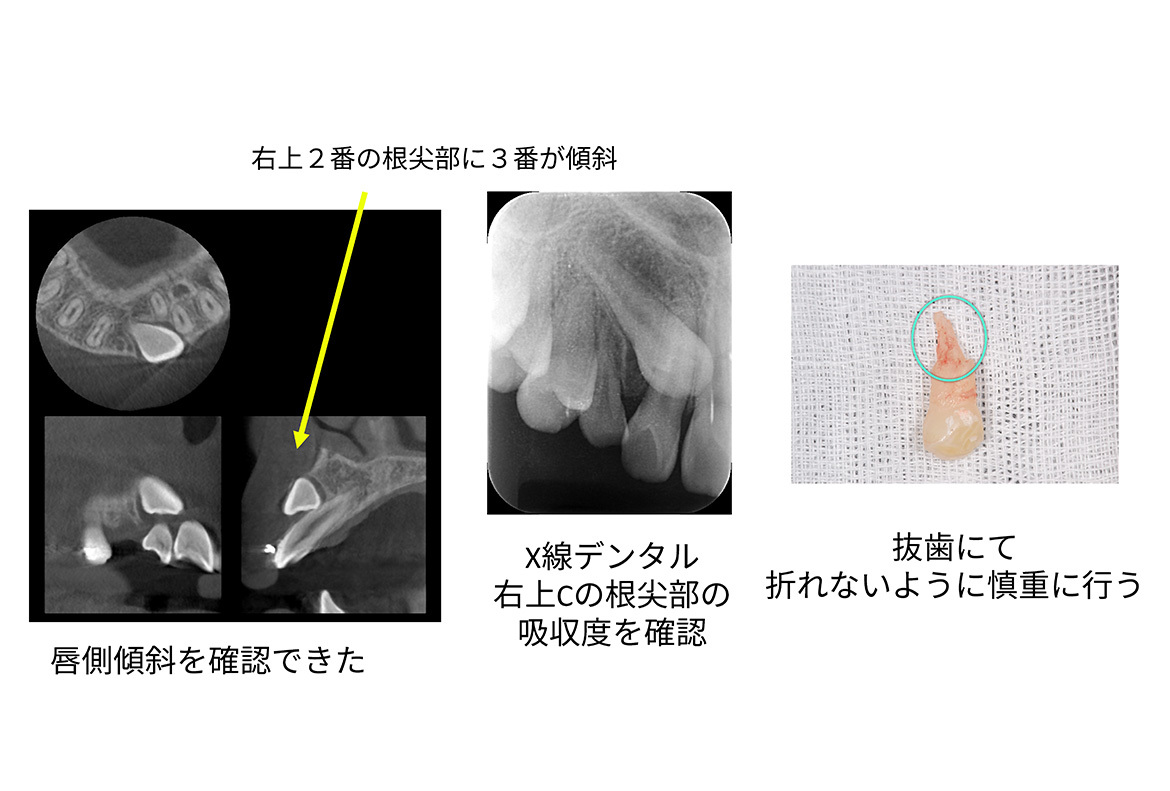 CT所見