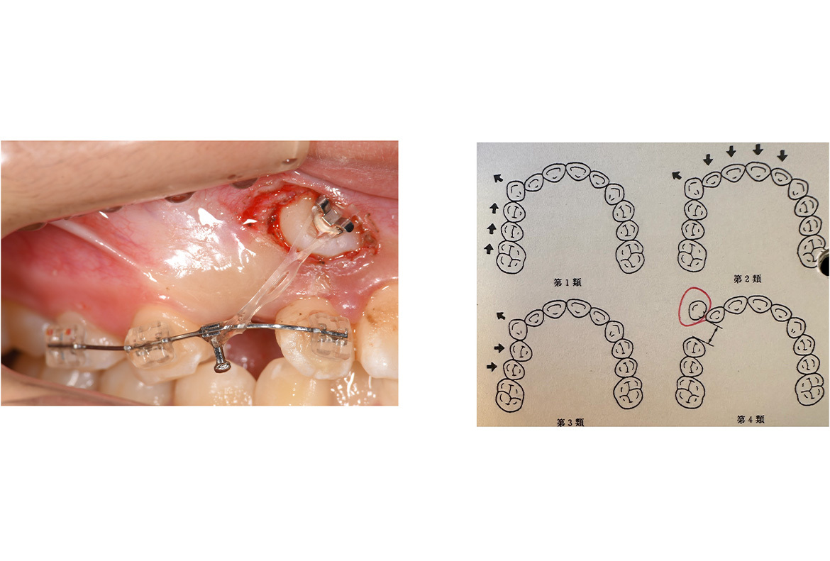 髙橋分類：上顎犬歯の低位唇側転位