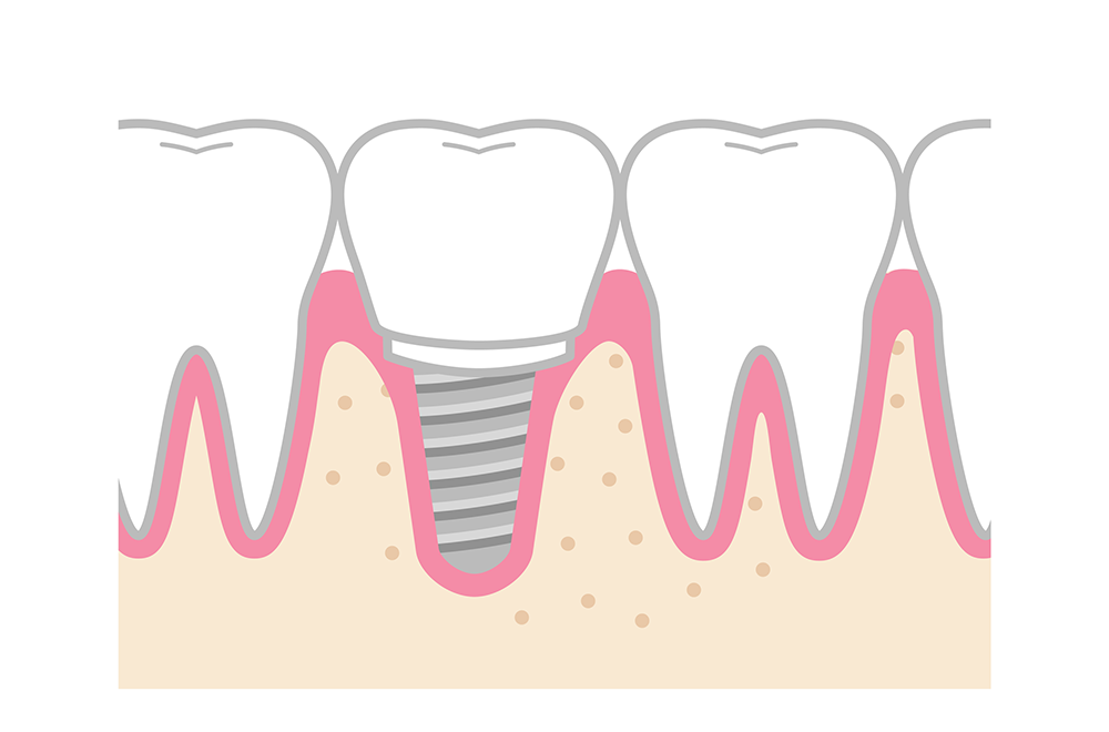 ① 埋入位置が良くなくインプラントを除去について